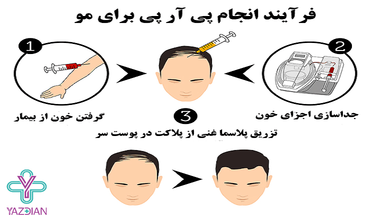 پی آر پی مو چیست؟برای چه کسانی مناسب است و چگونه عمل می‌کند